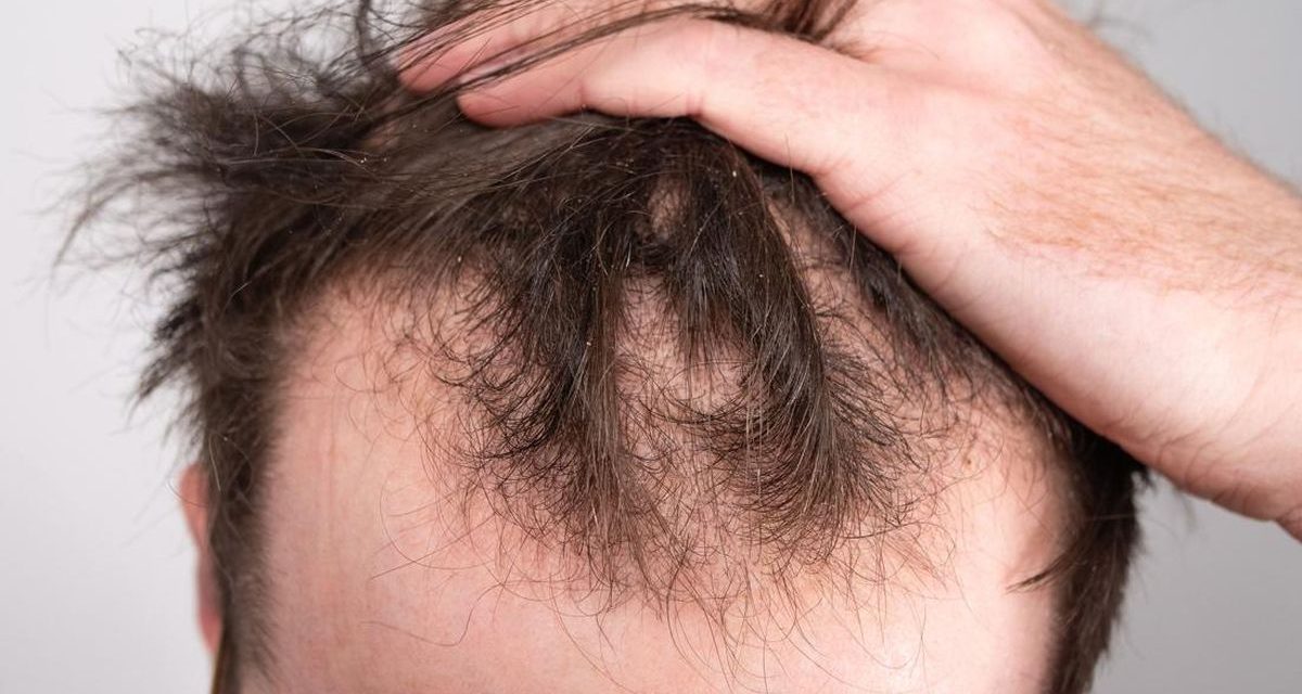 Akar Masalah Kebotakan Rambut Di Usia Muda Yang Intens