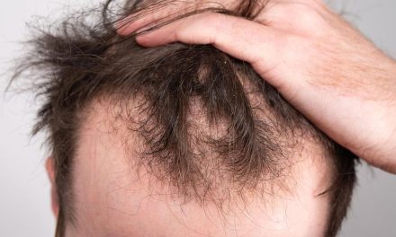 Akar Masalah Kebotakan Rambut Di Usia Muda Yang Intens