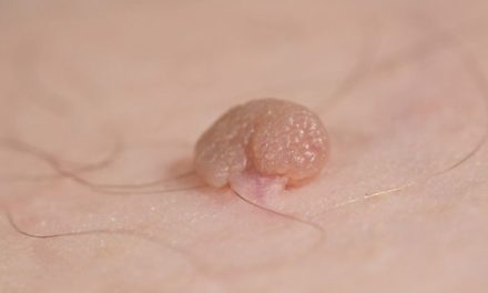 Pertumbuhan Kulit Kecil Atau Kutil Di Tubuh Seseorang