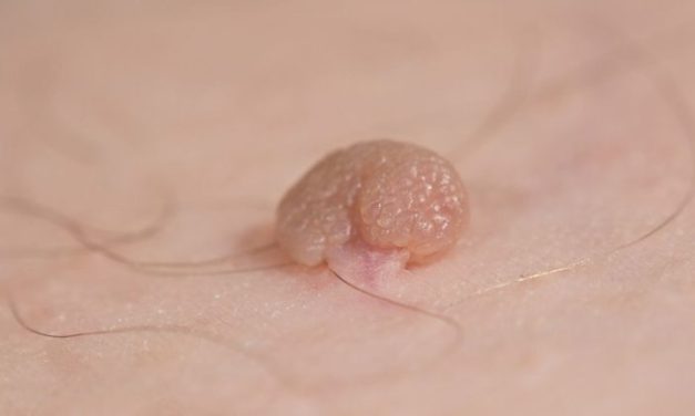 Pertumbuhan Kulit Kecil Atau Kutil Di Tubuh Seseorang