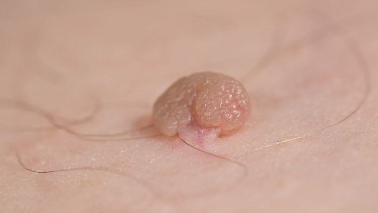 Pertumbuhan Kulit Kecil Atau Kutil Di Tubuh Seseorang