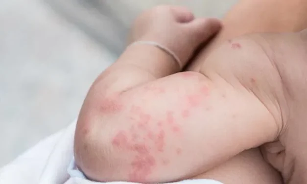 Formula Bedak Ampuh Kulit Bayi Yang Terkena Biang Keringat