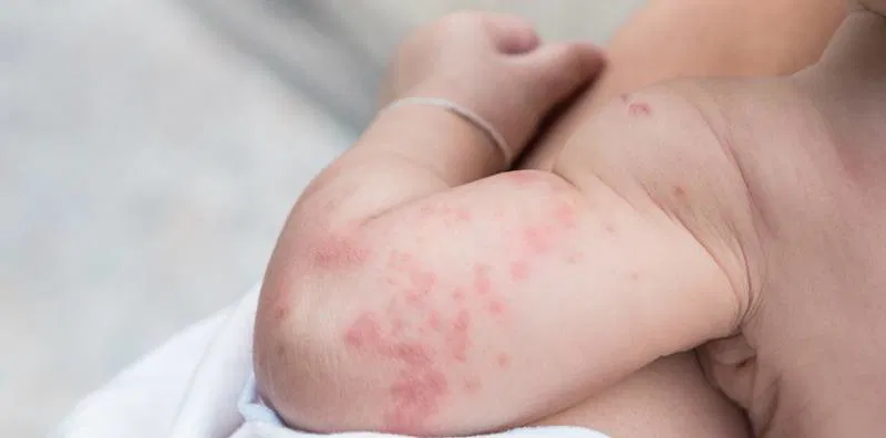 Formula Bedak Ampuh Kulit Bayi Yang Terkena Biang Keringat