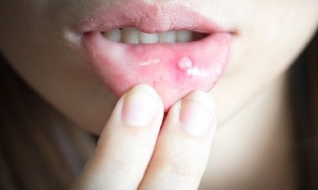 Luka Di Mulut Atau Sariawan Akibat Kekurangan Nutrisi