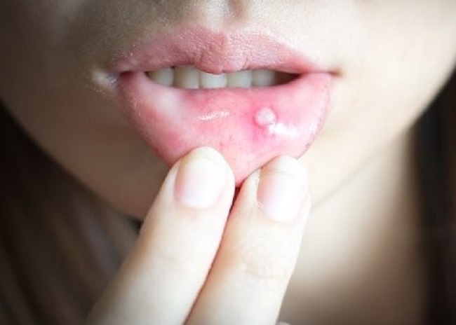 Luka Di Mulut Atau Sariawan Akibat Kekurangan Nutrisi