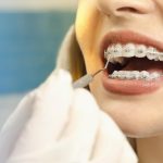 Tips Gigi Behel: Langkah Mudah Jaga Kebersihan Kawat & Gusi