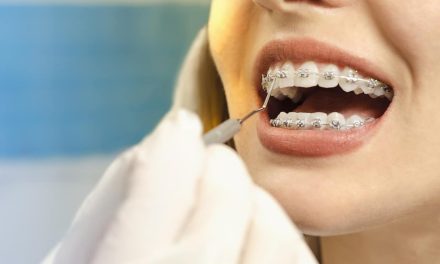 Tips Gigi Behel: Langkah Mudah Jaga Kebersihan Kawat & Gusi