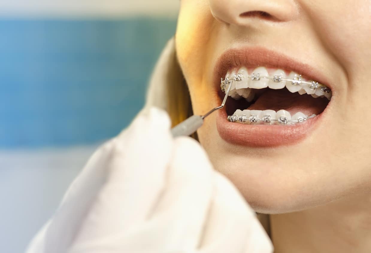 Tips Gigi Behel: Langkah Mudah Jaga Kebersihan Kawat & Gusi